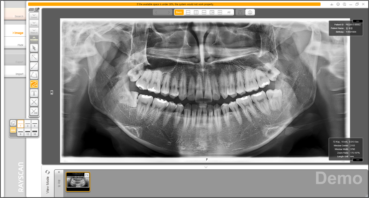 fmx dental template